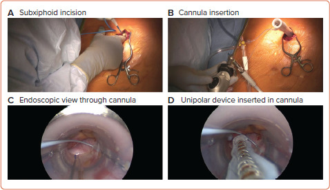 Hybrid Convergent Procedure for the Treatment of Persistent and Long-standing Persistent Atrial Fibrillation.