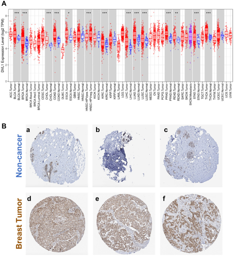 Genomic profiling of DVL-1 and its nuclear role as a transcriptional regulator in triple negative breast cancer.