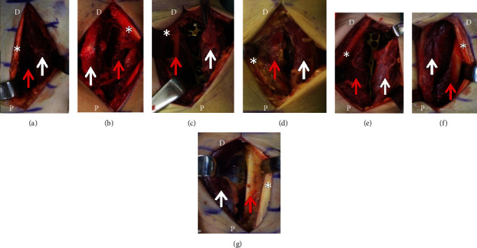 Surgical Exposure Technique for Volar Locking Plate Fixation of Distal Radius Fractures in Patients with Flexor Carpi Radialis Brevis Muscle Anomaly.