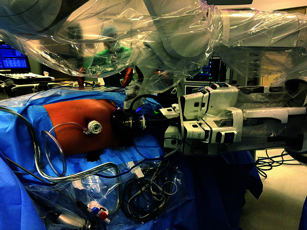 Robotic Single-Port Donor Nephrectomy with the da Vinci SP® Surgical System.