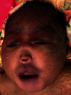 Alobar Holoprosencephaly with Cebocephaly in a Neonate Born to an HIV-Positive Mother in Eastern Uganda.