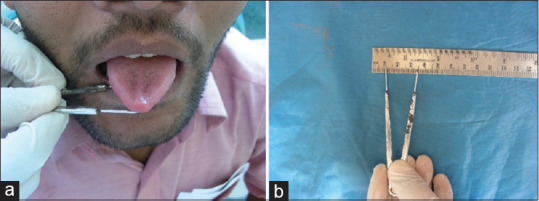 Assessment of correlation between clinical staging, functional staging, and histopathological grading of oral submucous fibrosis.