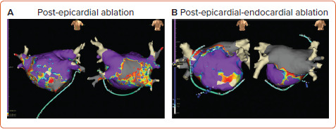 Hybrid Convergent Procedure for the Treatment of Persistent and Long-standing Persistent Atrial Fibrillation.