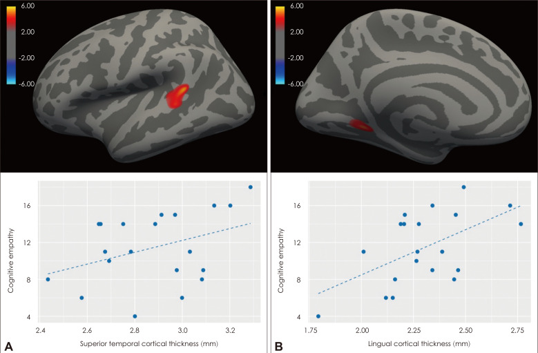 Disrupted Association Between Empathy and Brain Structure in Attention-Deficit/Hyperactivity Disorder.