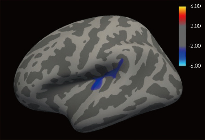 Disrupted Association Between Empathy and Brain Structure in Attention-Deficit/Hyperactivity Disorder.
