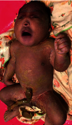 Alobar Holoprosencephaly with Cebocephaly in a Neonate Born to an HIV-Positive Mother in Eastern Uganda.