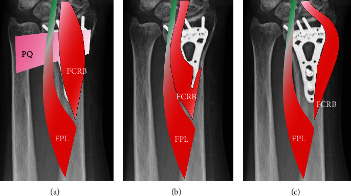 Surgical Exposure Technique for Volar Locking Plate Fixation of Distal Radius Fractures in Patients with Flexor Carpi Radialis Brevis Muscle Anomaly.