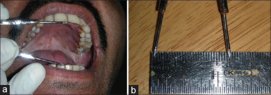 Assessment of correlation between clinical staging, functional staging, and histopathological grading of oral submucous fibrosis.