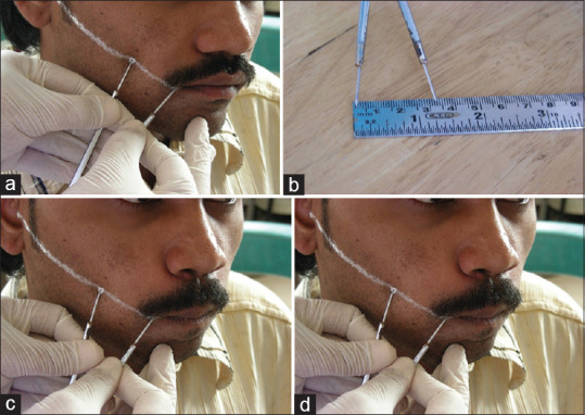 Assessment of correlation between clinical staging, functional staging, and histopathological grading of oral submucous fibrosis.