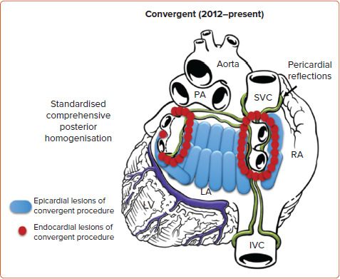 Hybrid Convergent Procedure for the Treatment of Persistent and Long-standing Persistent Atrial Fibrillation.