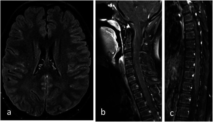 Extensive Longitudinal Transverse Myelitis Associated With CSF Epstein-Barr Virus Infection: A Case Report.