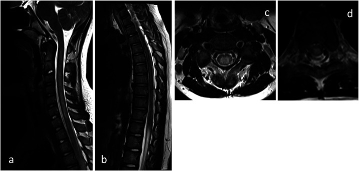 Extensive Longitudinal Transverse Myelitis Associated With CSF Epstein-Barr Virus Infection: A Case Report.