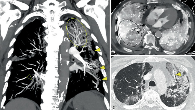 [COVID-19-induced coagulopathy and thrombosis manifestations].