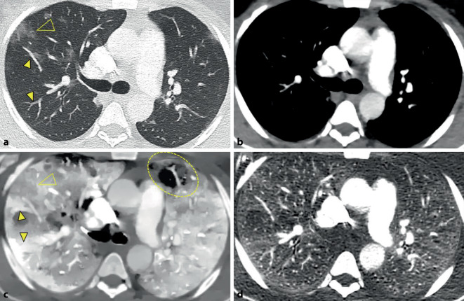 [COVID-19-induced coagulopathy and thrombosis manifestations].