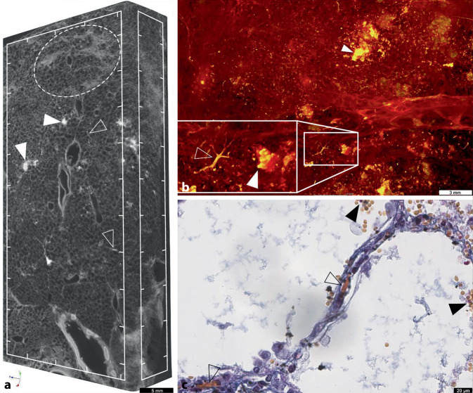 [COVID-19-induced coagulopathy and thrombosis manifestations].