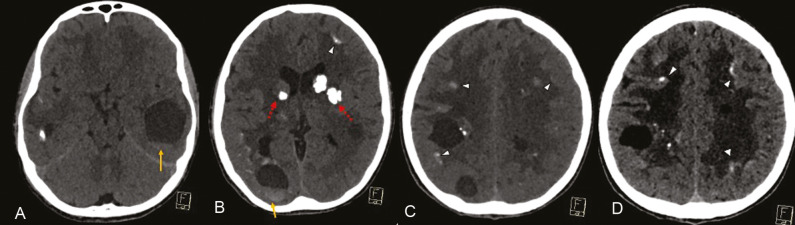 Leukoencephalopathy with Calcifications and Cysts in a Child with Progressive Hemiparesis-A Case Report.