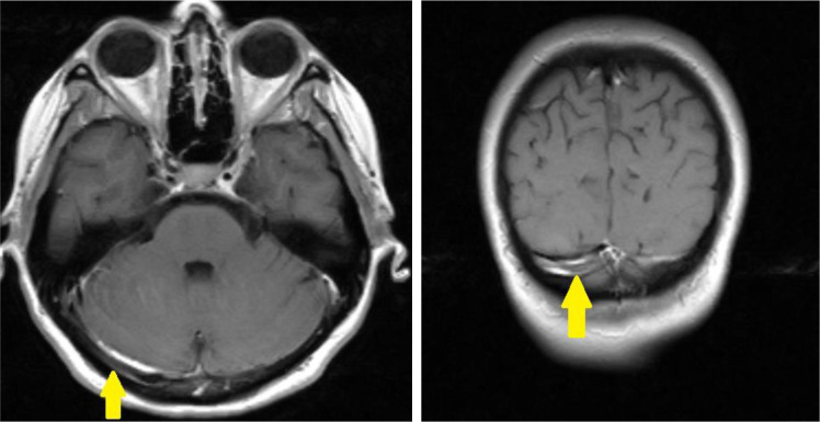 Cerebral vein thrombosis associated with MTHFR A1289C mutation gene in a young postpartum woman.