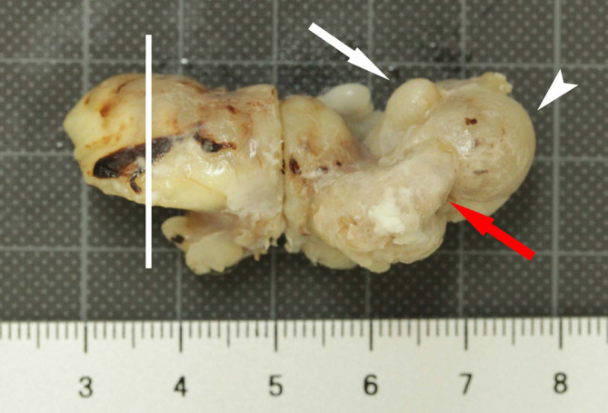 Spontaneous adenocarcinoma with giant cell formation in the accessory sex glands in a male Sprague-Dawley rat.