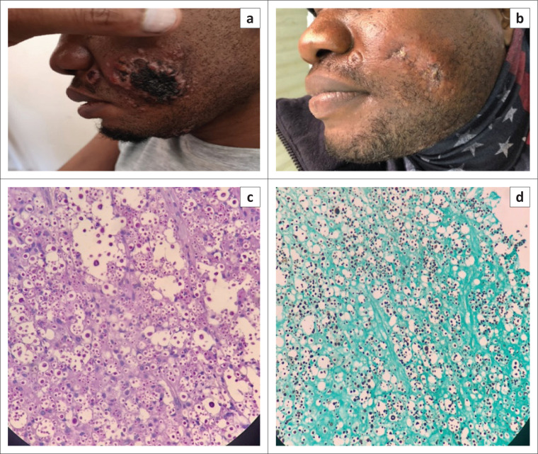 Cutaneous lesions in the setting of disseminated <i>Cryptococcus neoformans</i> infection.