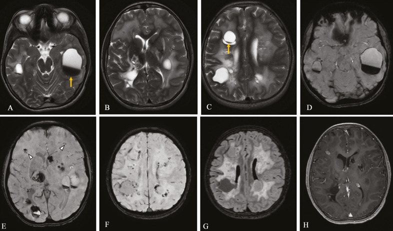 Leukoencephalopathy with Calcifications and Cysts in a Child with Progressive Hemiparesis-A Case Report.