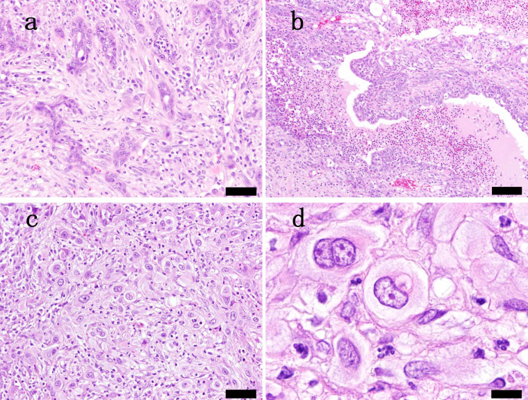 Spontaneous adenocarcinoma with giant cell formation in the accessory sex glands in a male Sprague-Dawley rat.