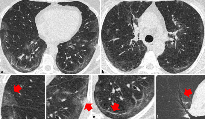 [Morphological and functional sequelae after COVID-19 pneumonia].