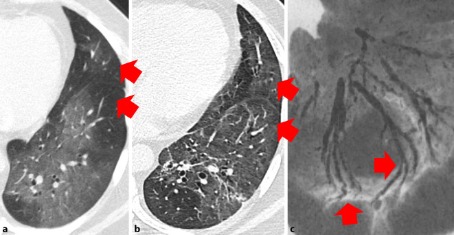 [Morphological and functional sequelae after COVID-19 pneumonia].