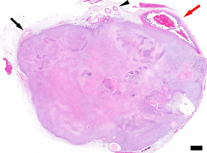 Spontaneous adenocarcinoma with giant cell formation in the accessory sex glands in a male Sprague-Dawley rat.