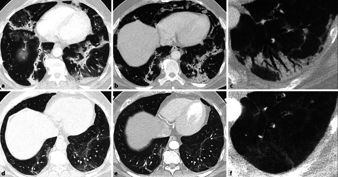 [Morphological and functional sequelae after COVID-19 pneumonia].