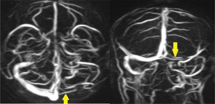 Cerebral vein thrombosis associated with MTHFR A1289C mutation gene in a young postpartum woman.