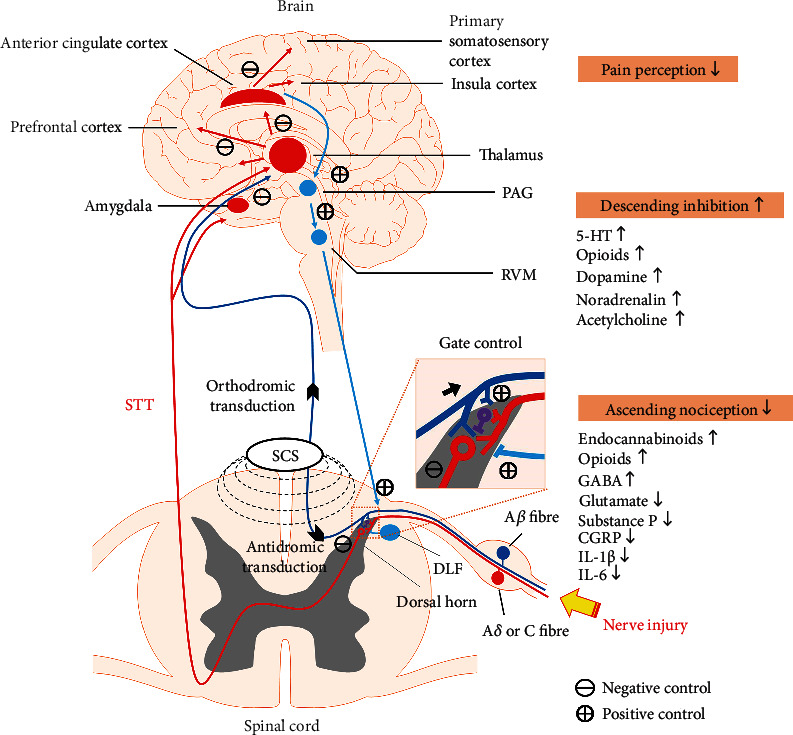 Spinal Cord Stimulation and Treatment of Peripheral or Central Neuropathic Pain: Mechanisms and Clinical Application.