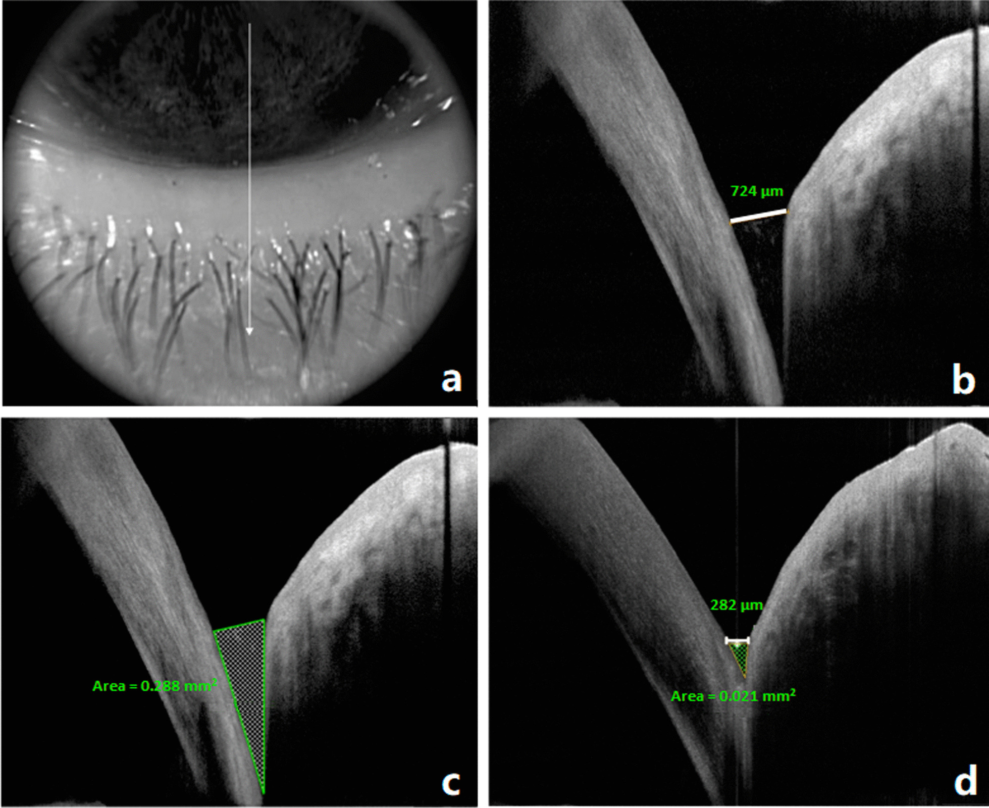 Evaluation of implanted perforated lacrimal punctal plugs using anterior segment optical coherence tomography.