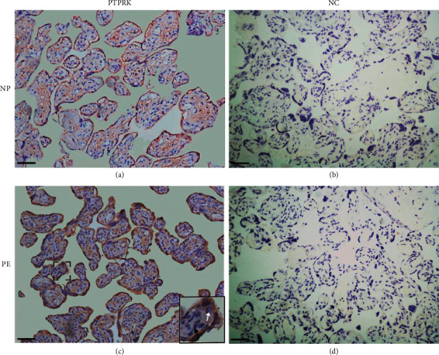 The Impact of <i>PTPRK</i> and <i>ROS1</i> Polymorphisms on the Preeclampsia Risk in Han Chinese Women.