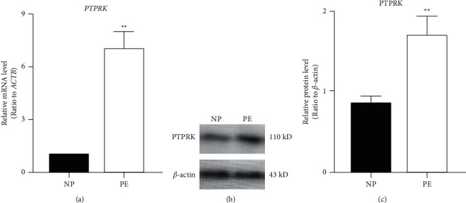 The Impact of <i>PTPRK</i> and <i>ROS1</i> Polymorphisms on the Preeclampsia Risk in Han Chinese Women.