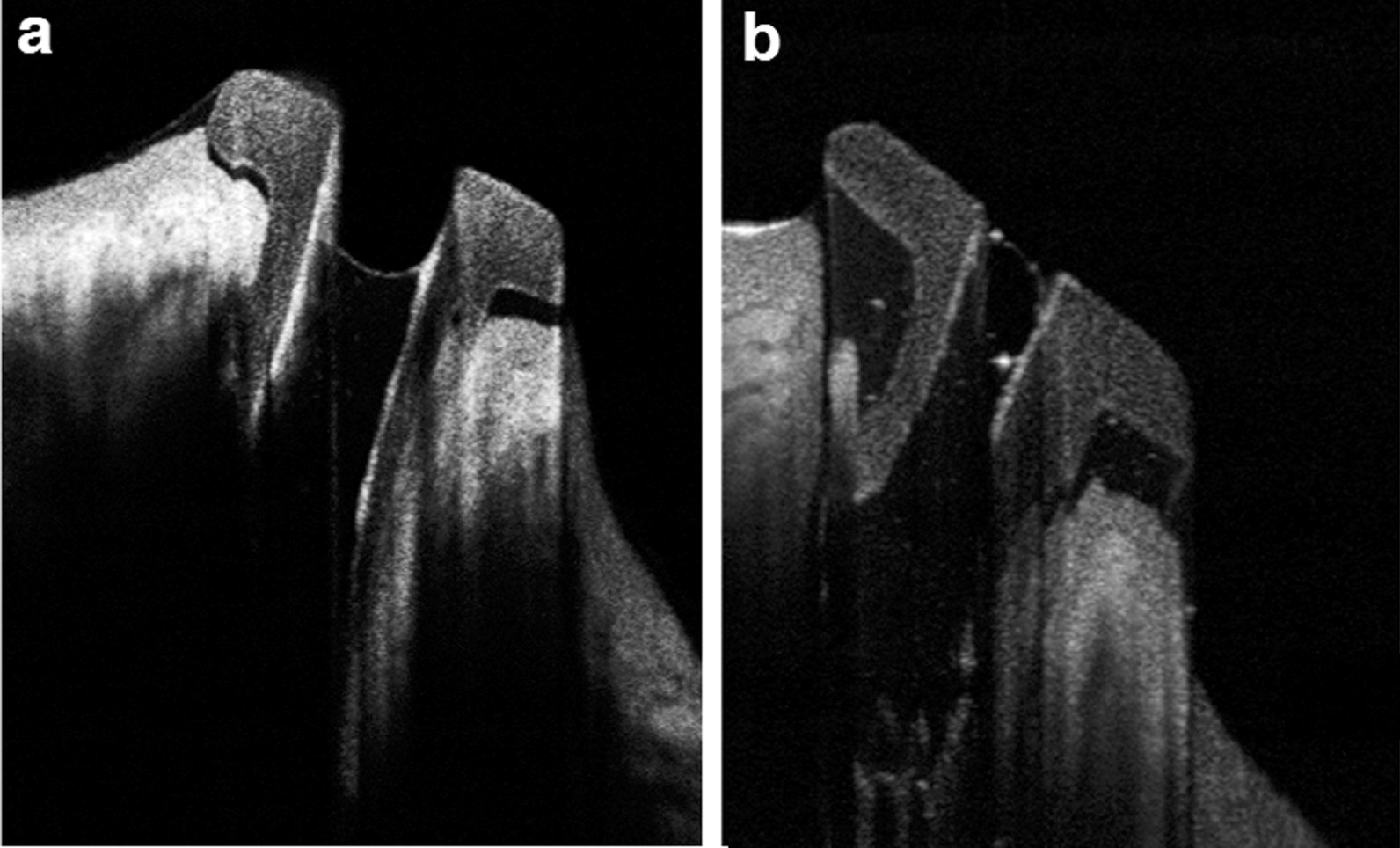 Evaluation of implanted perforated lacrimal punctal plugs using anterior segment optical coherence tomography.