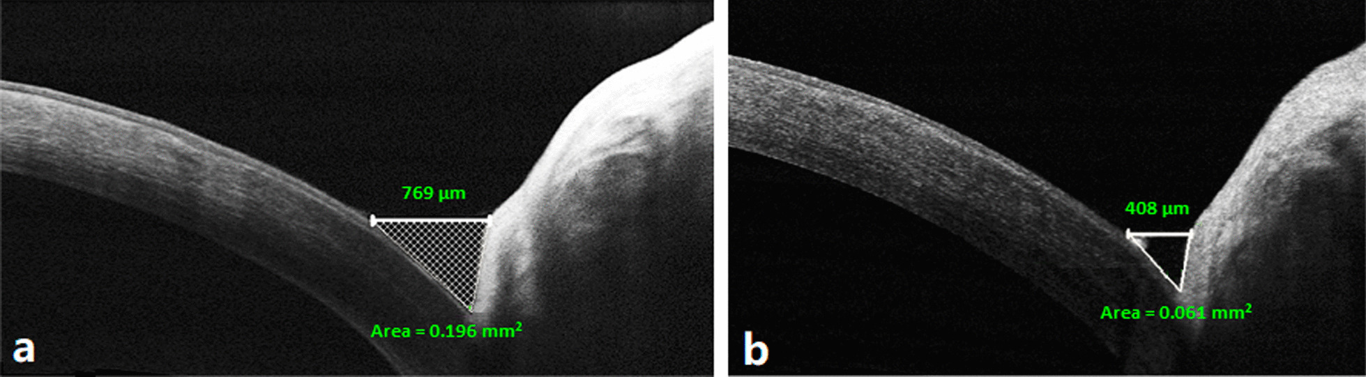 Evaluation of implanted perforated lacrimal punctal plugs using anterior segment optical coherence tomography.