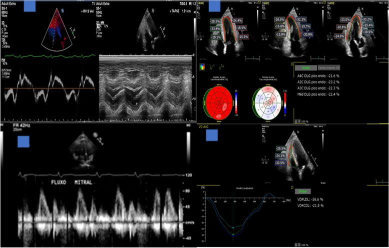 In-hospital COVID-19 infection echocardiographic analysis: a Brazilian, tertiary single-centre experience.