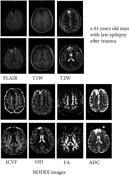 Experimental Imaging Study of Encephalomalacia Fluid-Attenuated Inversion Recovery (FLAIR) Hyperintense Lesions in Posttraumatic Epilepsy.