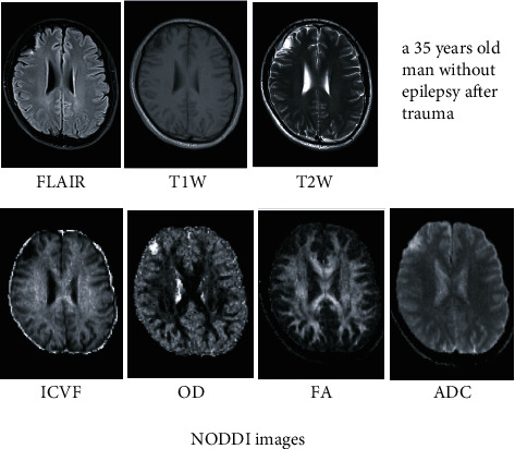 Experimental Imaging Study of Encephalomalacia Fluid-Attenuated Inversion Recovery (FLAIR) Hyperintense Lesions in Posttraumatic Epilepsy.