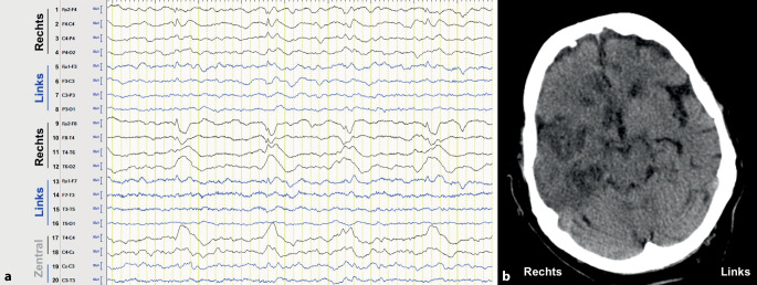 [Pharmacotherapy and intensive care aspects of status epilepticus: update 2020/2021].