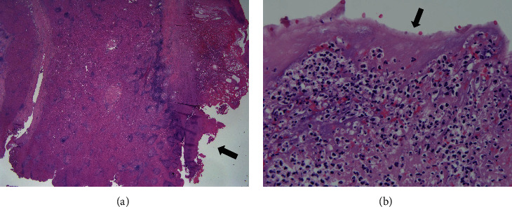 Perihepatic Abscess due to a Liver Suture with Pledgets Used to Treat a Penetrating Liver Injury.