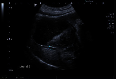 Myxedema Coma and Acute Hepatopathy in a Dog with Severe Atherosclerosis.