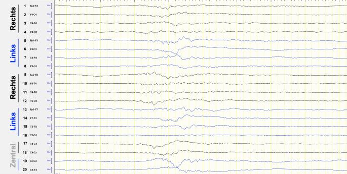 [Pharmacotherapy and intensive care aspects of status epilepticus: update 2020/2021].