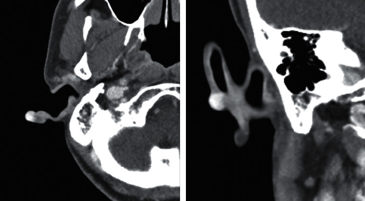 Arteriovenous Malformation in the Auricle in a 59-Year-Old Woman.