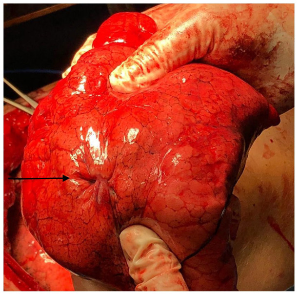 Pulmonary Large Cell Neuroendocrine Carcinoma Associated With Lambert-Eaton Syndrome.
