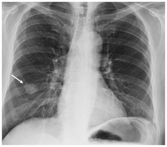 Pulmonary Large Cell Neuroendocrine Carcinoma Associated With Lambert-Eaton Syndrome.