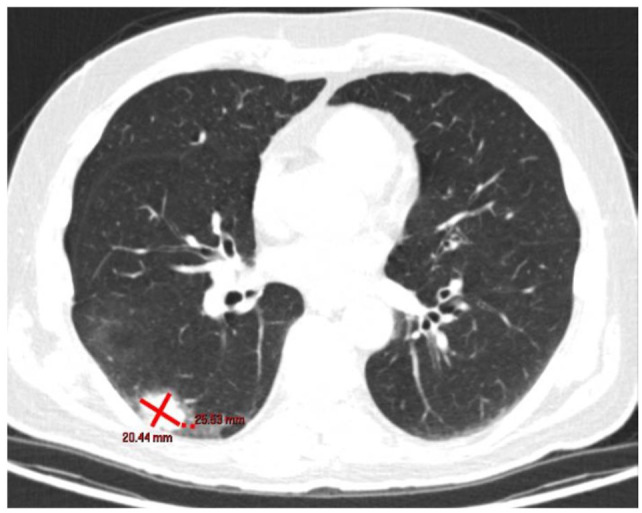 Pulmonary Large Cell Neuroendocrine Carcinoma Associated With Lambert-Eaton Syndrome.