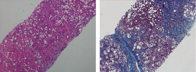 <i>Veillonella</i> Bacteremia in Alcoholic Hepatitis.