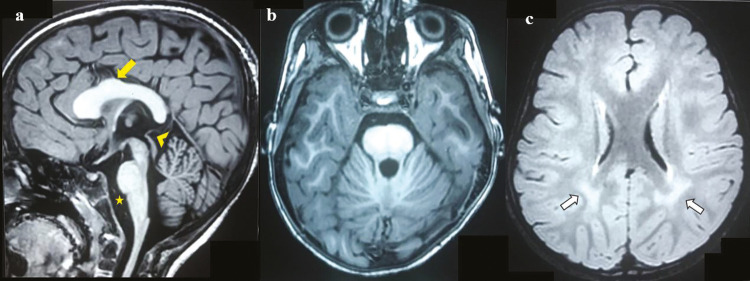 The Dysfunctional Gangway: <i>SZT2</i>-associated Epilepsy with Thick Corpus Callosum.