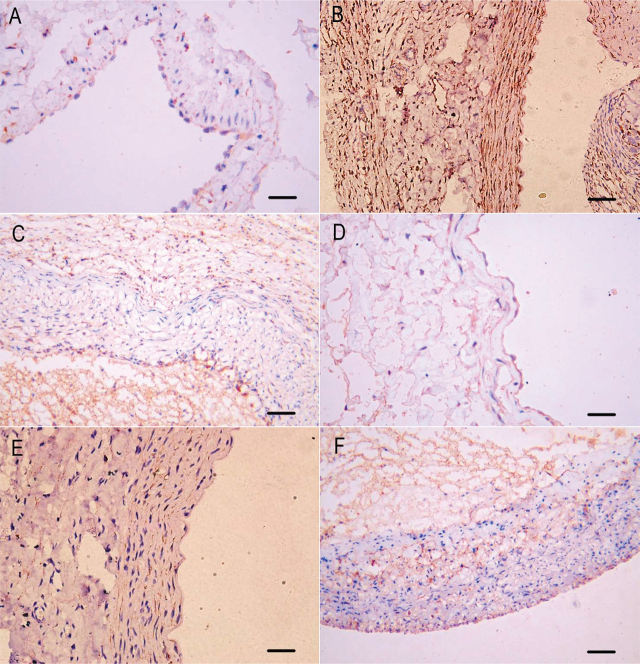 Hydraulic expansion facilitates remodeling of arteriovenous fistulas without increasing venous intimal hyperplasia in rabbits.